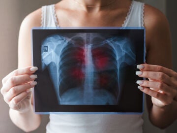 La tuberculosis es la enfermedad infecciosa m&aacute;s letal a nivel mundial