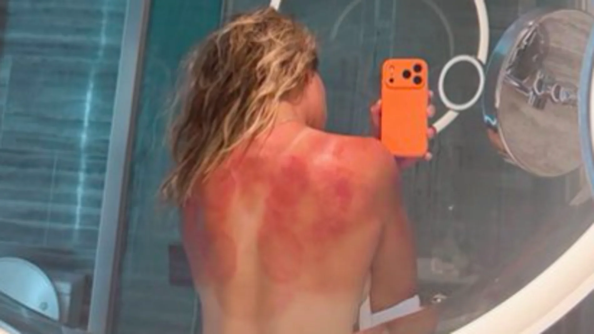 Así quedó la espalda de Renata Zarazúa