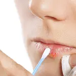 Herpes labial