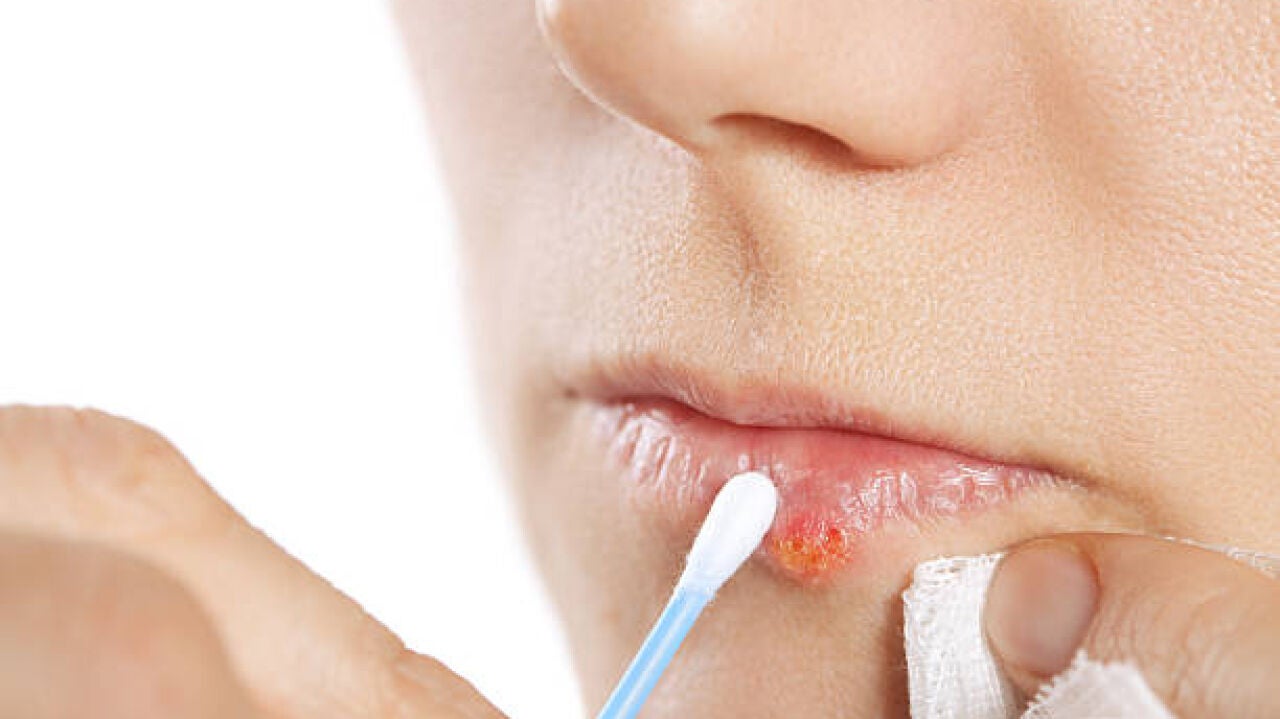 Un estudio detecta que el herpes labial genera cambios cerebrales asociados al alzhéimer