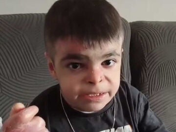 Leo, el ni&ntilde;o de 12 a&ntilde;os con piel de mariposa: "Lo m&aacute;s doloroso es que un ni&ntilde;o normal no siente dolor todos los d&iacute;as, personas como nosotros lamentablemente s&iacute;" 