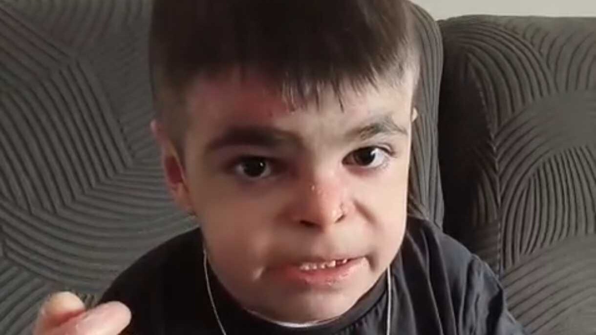 Las redes se movilizan para acabar con el dolor de Leo , el niño sevillano de 12 años con Piel de Mariposa