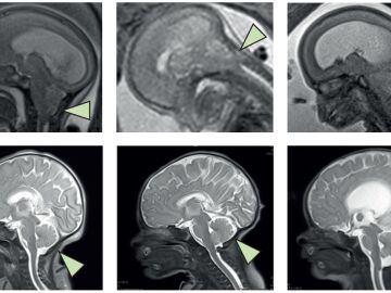Las im&aacute;genes de resonancia magn&eacute;tica muestran el cerebro en perfil. Antes de la operaci&oacute;n (fila superior), la flecha se&ntilde;ala el rombenc&eacute;falo (parte inferior del cerebro) herniado hacia el canal espinal. Despu&eacute;s de la operaci&oacute;n (fila inferior), la flecha muestra que el rombenc&eacute;falo ha vuelto a su posici&oacute;n normal dentro del cr&aacute;neo.