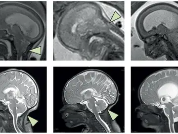 Las imágenes de resonancia magnética muestran el cerebro en perfil. Antes de la operación (fila superior), la flecha señala el rombencéfalo (parte inferior del cerebro) herniado hacia el canal espinal. Después de la operación (fila inferior), la flecha muestra que el rombencéfalo ha vuelto a su posición normal dentro del cráneo. Las imágenes de resonancia magnética muestran el cerebro en perfil. Antes de la operación (fila superior), la flecha señala el rombencéfalo (parte inferior del cerebro) herniado hacia el canal espinal. Después de la operación (fila inferior), la flecha muestra que el rombencéfalo ha vuelto a su posición normal dentro del cráneo.