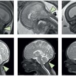 Las im&aacute;genes de resonancia magn&eacute;tica muestran el cerebro en perfil. Antes de la operaci&oacute;n (fila superior), la flecha se&ntilde;ala el rombenc&eacute;falo (parte inferior del cerebro) herniado hacia el canal espinal. Despu&eacute;s de la operaci&oacute;n (fila inferior), la flecha muestra que el rombenc&eacute;falo ha vuelto a su posici&oacute;n normal dentro del cr&aacute;neo.
