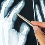 Radiograf&iacute;a de artrosis articular o reuma