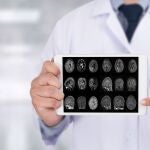 Un estudio identifica las condiciones m&eacute;dicas que suelen predecir el Alzheimer para poder intervenir antes