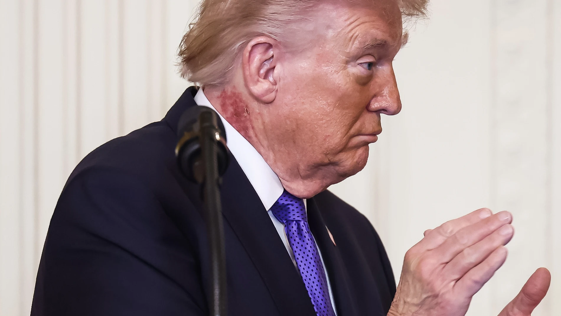 WASHINGTON (United States), 02/03/2026.- US President Donald Trump attends a medal of honor ceremony in the East Room of the White House in Washington, DC, USA, 02 March 2026. The President has a red rash on the right side of his neck. EFE/EPA/JIM LO SCALZO / POOL