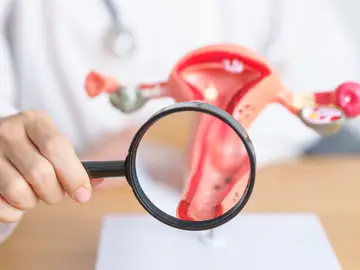 La endometriosis está caracterizada por la presencia de tejido endometrial fuera de la cavidad uterina La endometriosis está caracterizada por la presencia de tejido endometrial fuera de la cavidad uterina