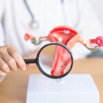 La endometriosis est&aacute; caracterizada por la presencia de tejido endometrial fuera de la cavidad uterina 