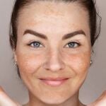 Melasma en el rostro con manchas visibles en frente y mejillas