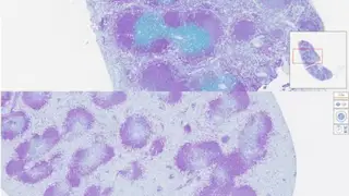 En la imagen superior, en azul, las células dañadas y en la imagen inferior el daño ha desaparecido. Oncología