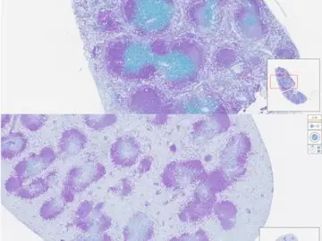 En la imagen superior, en azul, las células dañadas y en la imagen inferior el daño ha desaparecido. Oncología