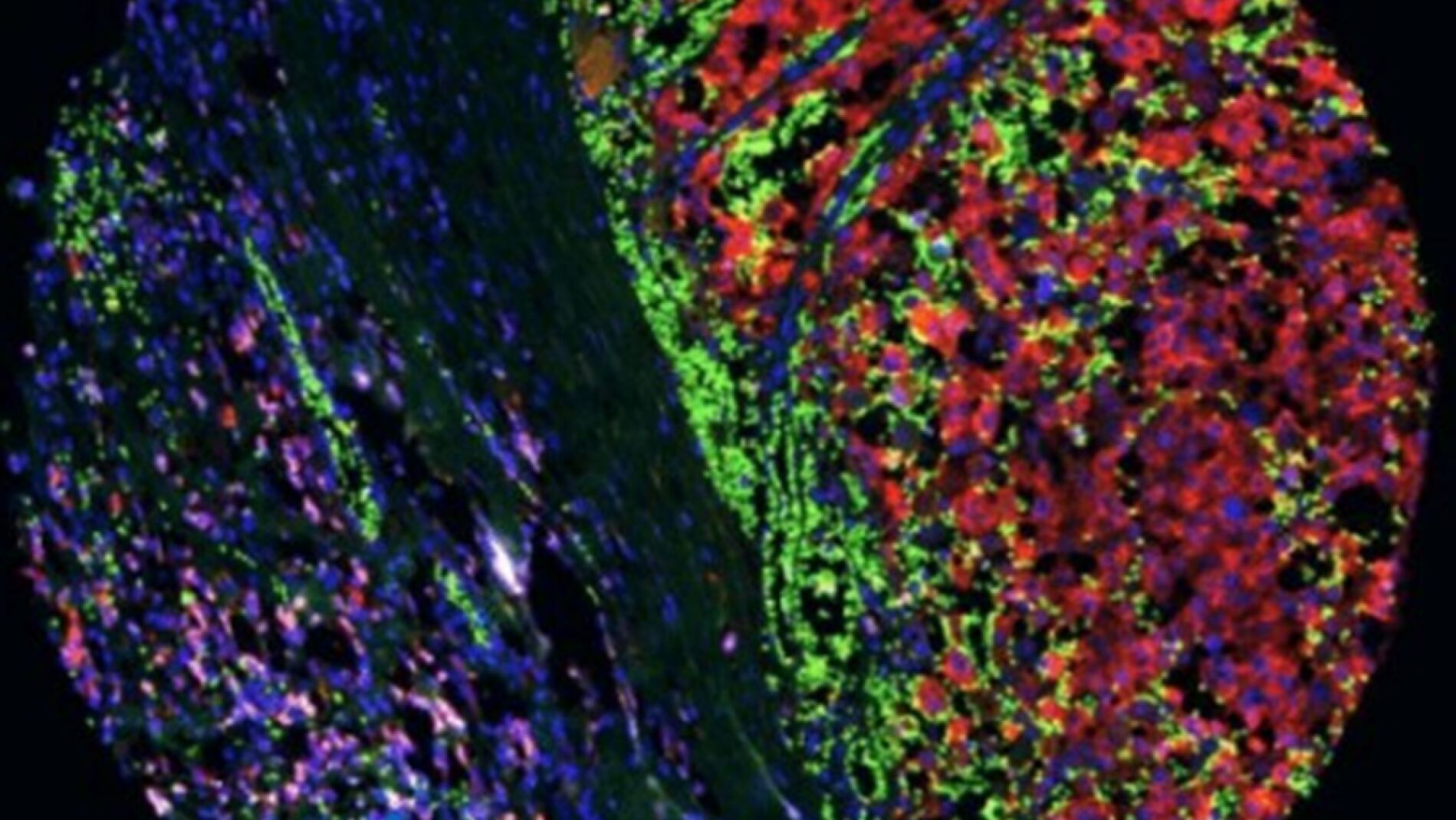 Científicos españoles dan con una nueva vía para reducir la metástasis del melanoma
