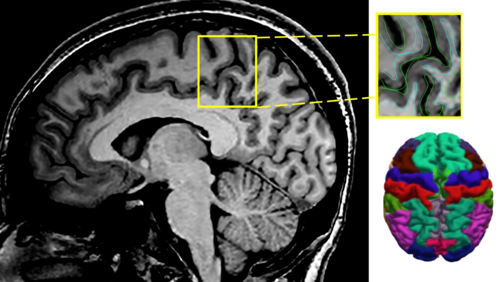 Imagen centrada en el grosor cortical