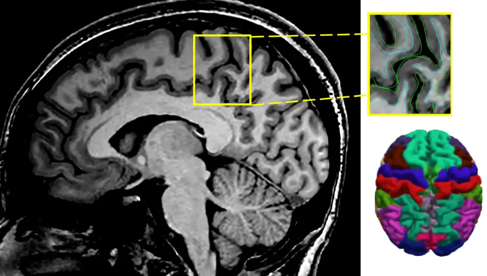 Imagen centrada en el grosor cortical