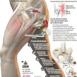 Una nueva técnica coloca prótesis de cadera con mínima incisión