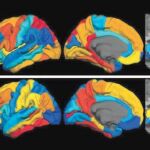 La actividad de Tau en los diez voluntarios que padecían alzhéimer era especialmente diferente en los lóbulos temporales y en la corteza cerebral