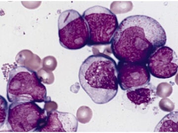C&eacute;lulas de leucemia