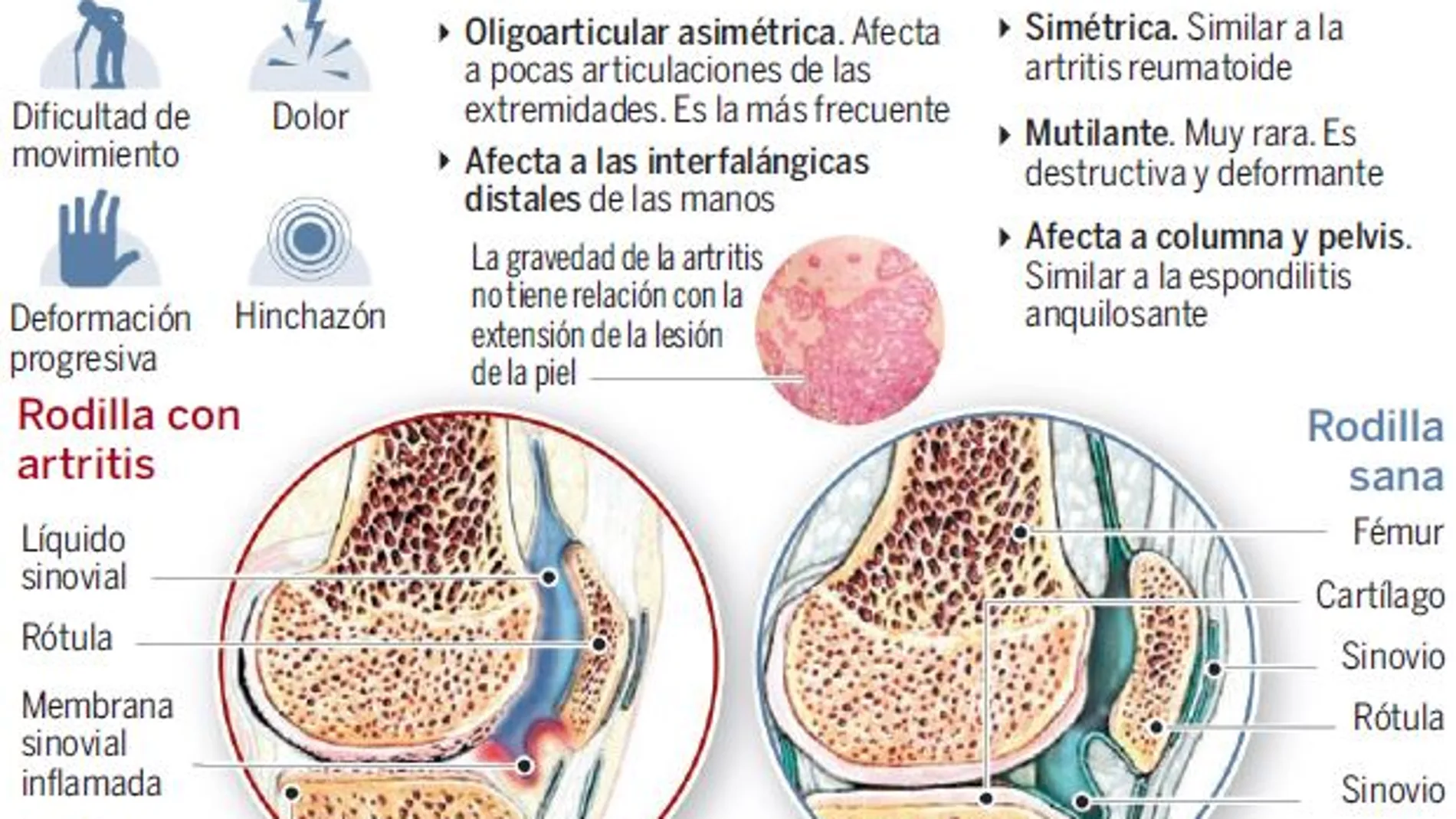 Aterriza en España el fármaco más eficaz contra la artritis psoriásica