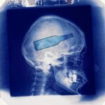 El consumo intensivo entre menores afecta a su cerebro a nivel estructural y funcional