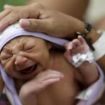 Un bebé con microencefalia