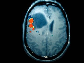 Esc&aacute;ner de un tumor cerebral