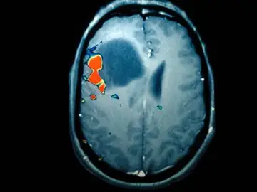 Escáner de un tumor cerebral Escáner de un tumor cerebral