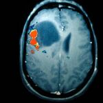 Escáner de un tumor cerebral