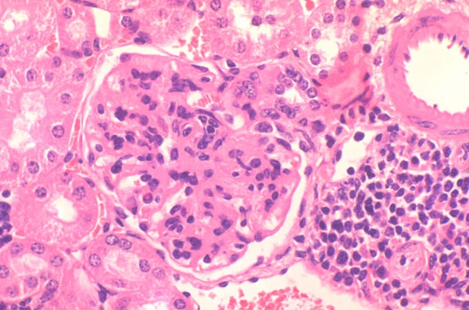 Imagen representativa de glomerulonefritis autoinmune característica de lupus eritematoso sistémico