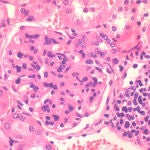 Imagen representativa de glomerulonefritis autoinmune característica de lupus eritematoso sistémico
