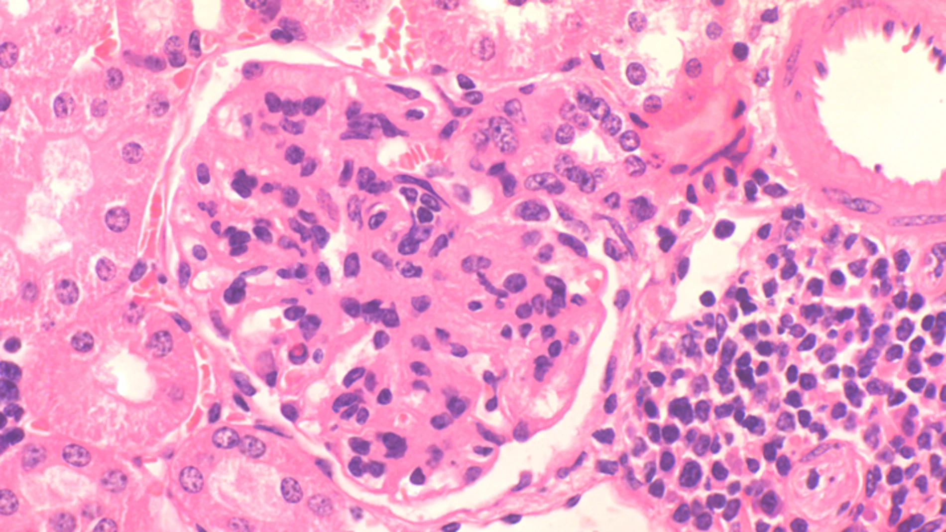 Imagen representativa de glomerulonefritis autoinmune característica de lupus eritematoso sistémico
