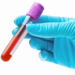 Los investigadores han desarrollado un innovador análisis de sangre que predice el riesgo de la esquizofrenia 