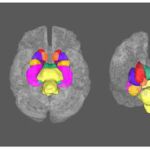Descubren vínculos entre la materia blanca del cerebro y la depresión