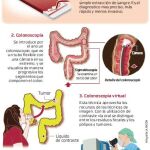 Una muestra de sangre para detectar el cáncer colorrectal