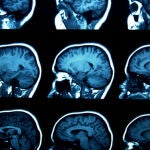 Entre el 7 y el 20% de los pacientes con melanoma tienen metástasis cerebral en el momento del diagnóstico, porcentaje que aumenta hasta el 70% en fases posteriores de la enfermedad