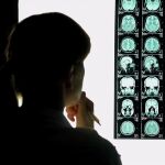 Según el grado de afectación, las secuelas del ictus serán mas o menos difíciles de anular | Imagen cedida