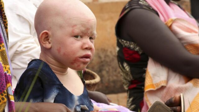 Imagen de un niño albino de Burundi