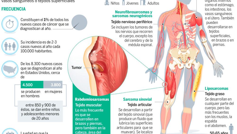 sarcoma melanótico metastásico Sarcoma: buenas noticias para uno de los tumores más mortiferos