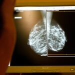 Radiografía de cáncer de mama / Foto: Reuters