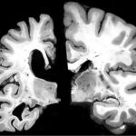 Alzhéimer: Los desafíos de la patología