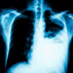 El cáncer de pulmón es el tercero más frecuente y principal causa de muerte por cáncer, tanto en hombres como en mujeres