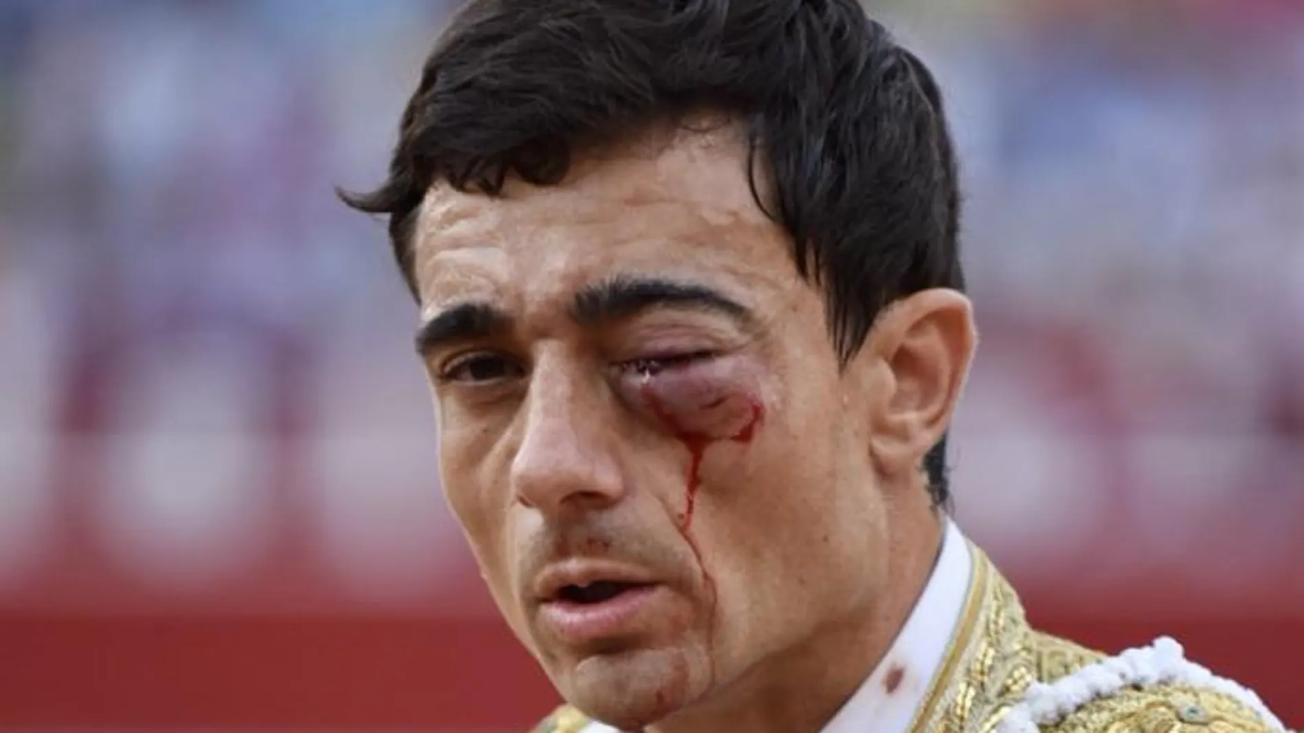 Imagen de la lesión ocular de Ureña / Foto: ALCOLEA