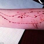 Imagen de un brazo con cortes en forma de ballena azul