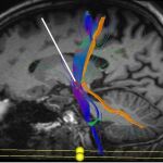 Radiografía cerebral por enfermedad de Parkinson | Ep