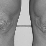 Escaras en la piel de pacientes con Ehlers-Danlos tipo III (EDS)
