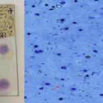 Izquierda: dos de las preparaciones antiguas empleadas en el estudio. Derecha: bajo el microscopio, a 400 aumentos, pueden distinguirse algunos parásitos de la malaria
