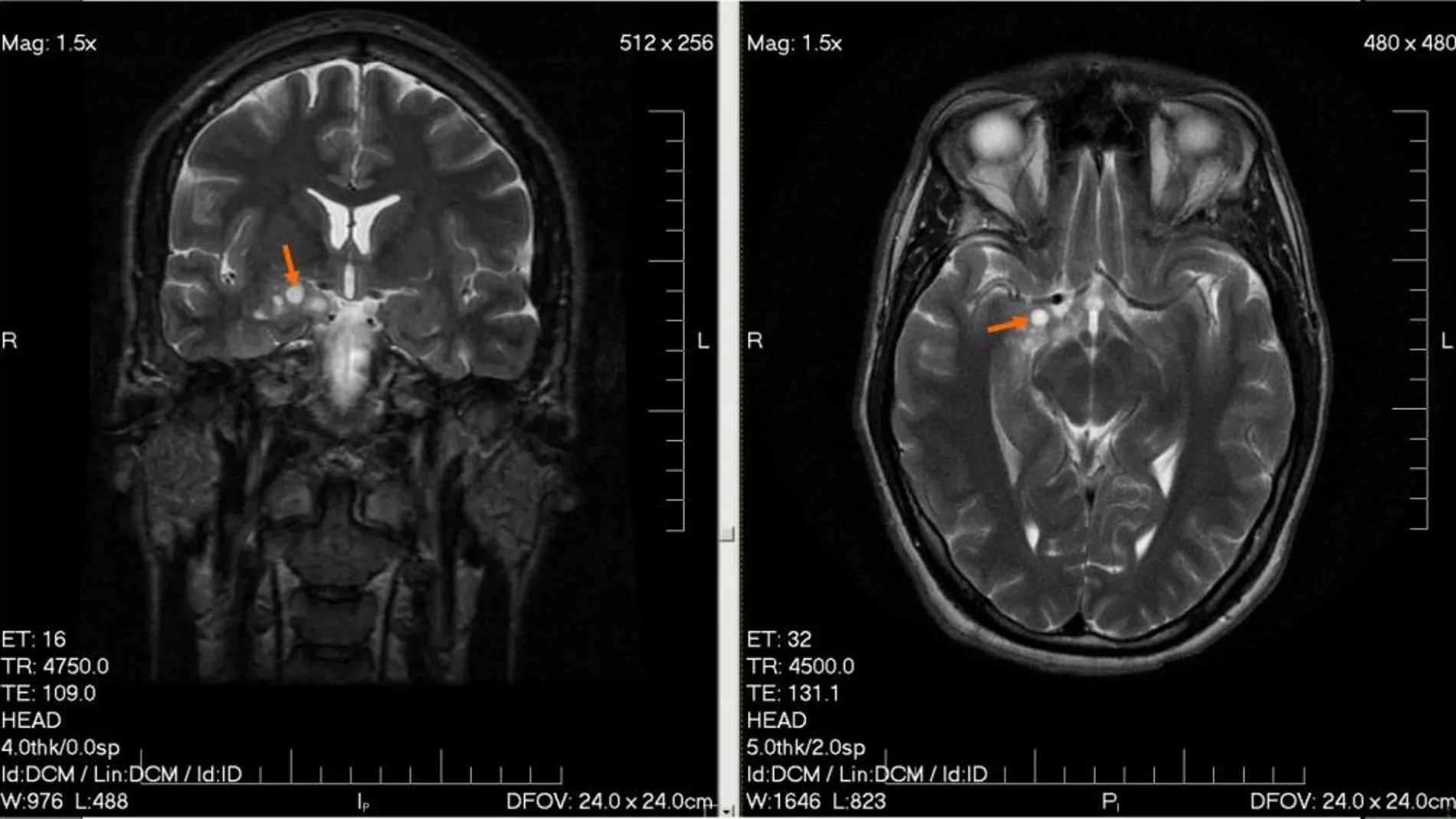 Localización de un glioma