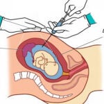Lo que nunca nos han contado sobre la Amniocentesis