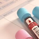 Para los pacientes, la biopsia líquida no se diferencia de cualquier otra toma de sangre.